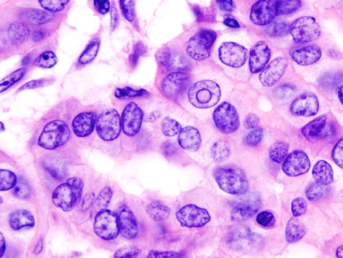 קובץ:Thyroid papillary carcinoma histopathology (4).jpg