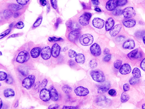 File:Thyroid papillary carcinoma histopathology (4).jpg