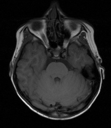 File:Anaplastisches Ependymom - MRT - T1 axial - 008.jpg