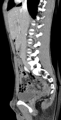 CT of a normal abdomen and pelvis, sagittal plane 79.png