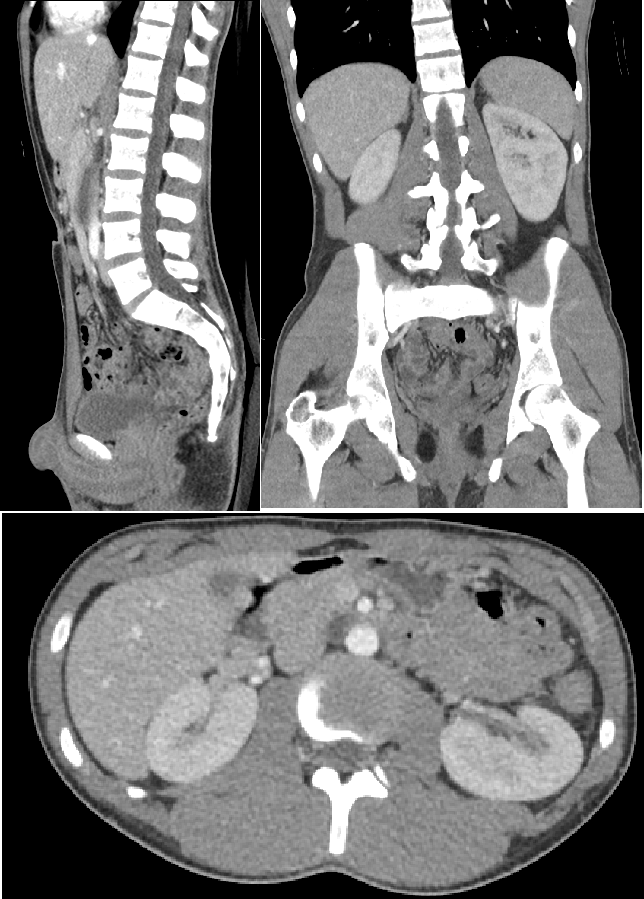 Computed Tomography Of The Abdomen And Pelvis Wikipedia