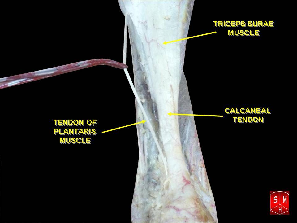 calcaneal tendon