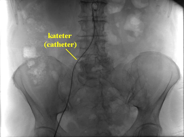 File:Catheterization selective angiography.JPG