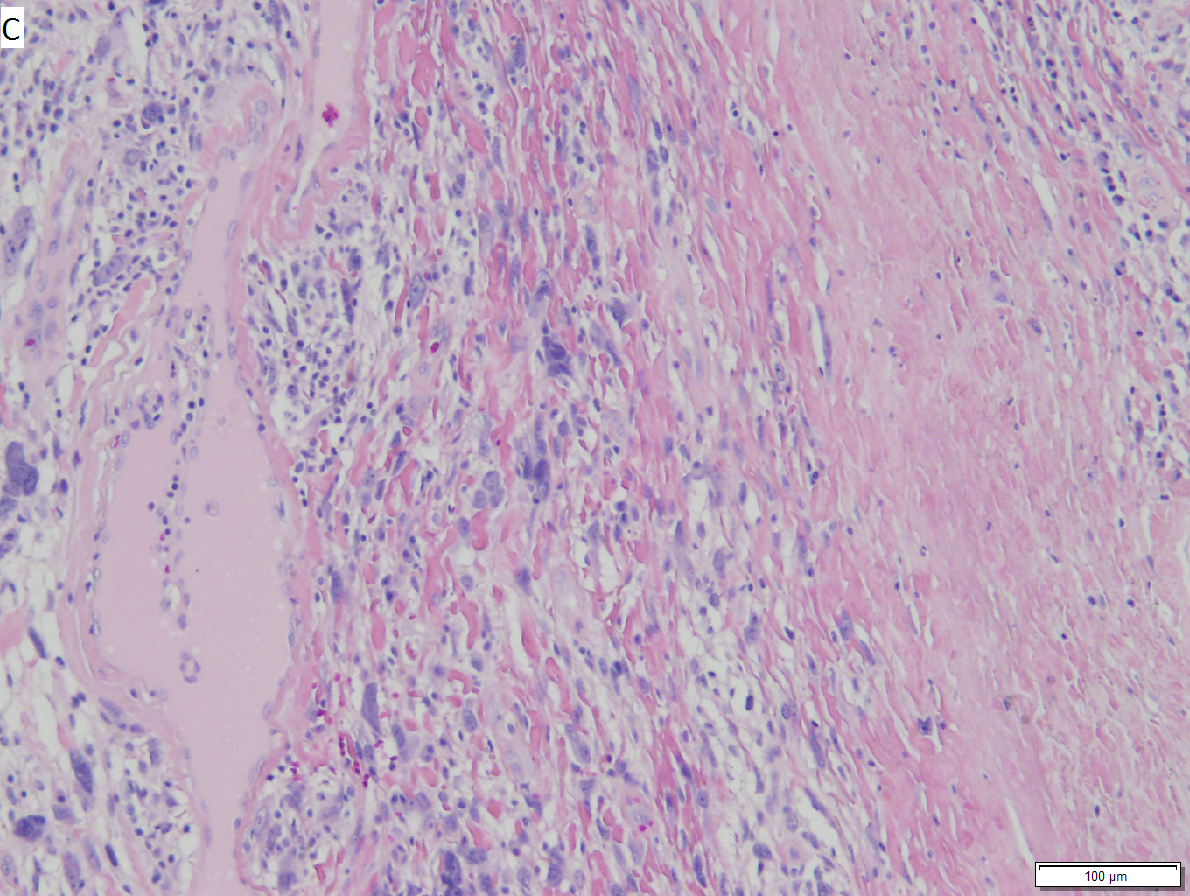 Pleomorphic hyalinizing angioectatic tumor of soft parts (subcutis).