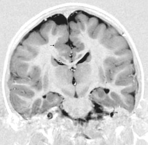 File:Polymicrogyria arrows.JPG