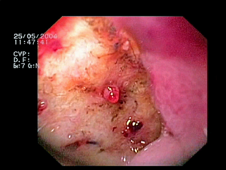 File:Ulcer Visible Vessel.jpg