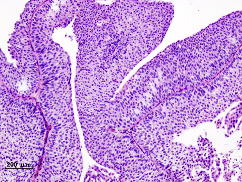 Urinary bladder papilloma histology - Colorectal cancer cdc