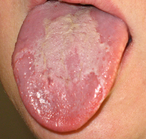 File:Human geographic tongue.jpg