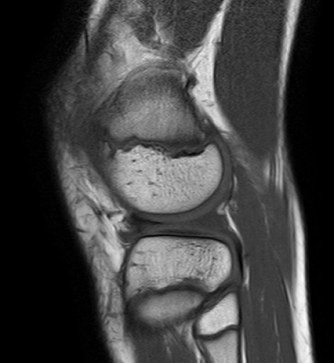 File:Korbhenkelriss Aussenmeniskus Hinterhorn - 14jm - MRT - T1 sagittal - 020.jpg