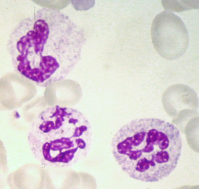 Neutrophil hypersegmenté (carence en B12)