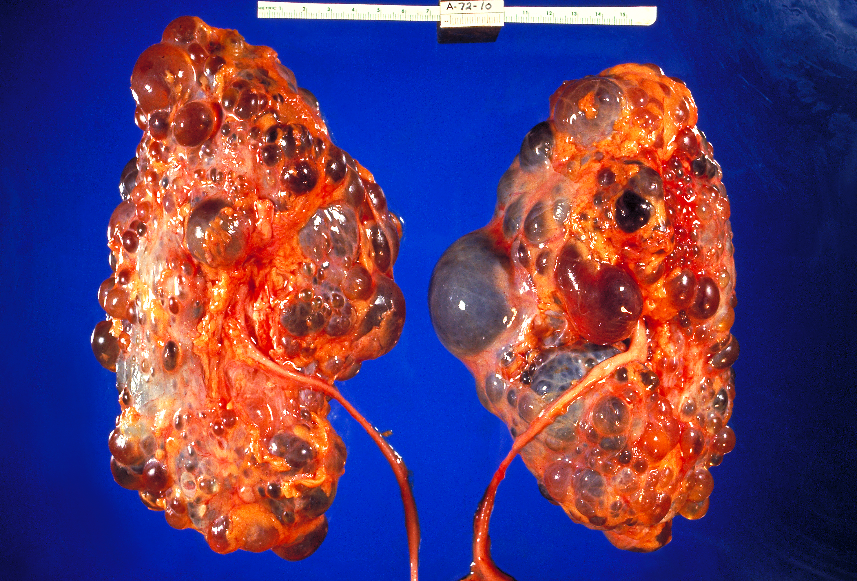 Autosomal Dominant Polycystic Kidney Disease: Symptoms and Causes