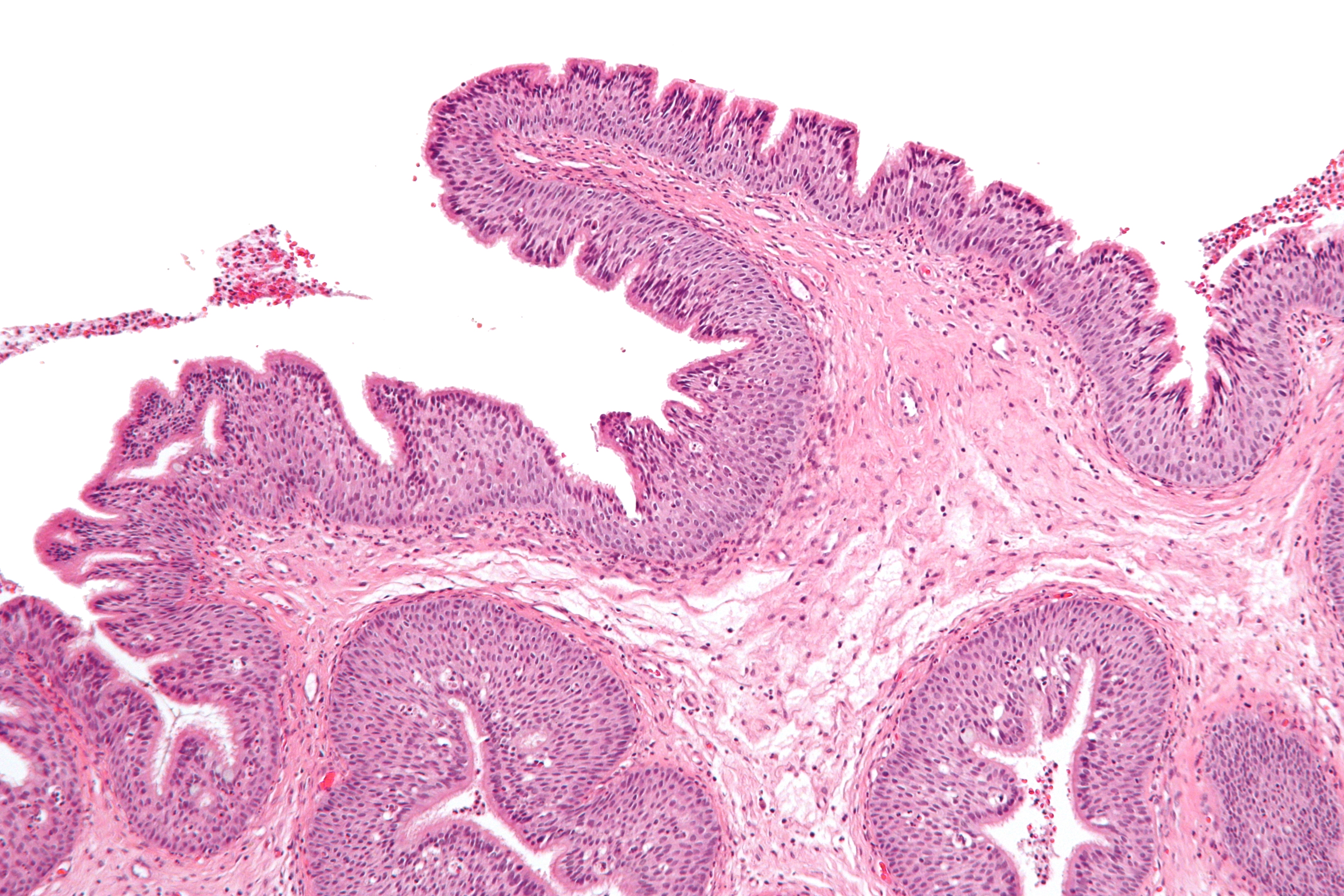 inverted sinonasal papilloma pathology