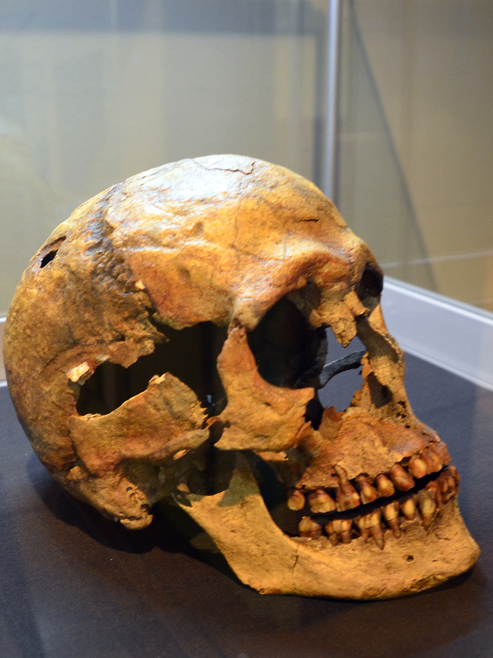 File 0 0432 Trepanated Skull Of A Man Hallstatt Period Of The Lusatian Culture Rakow Jpg Wikimedia Commons