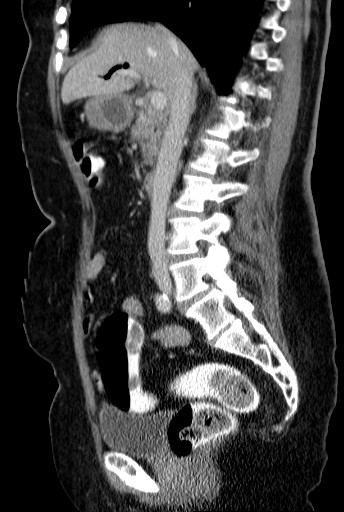 File:Bouveret-Syndrom case 001 - CT - sagittal - 015.jpg