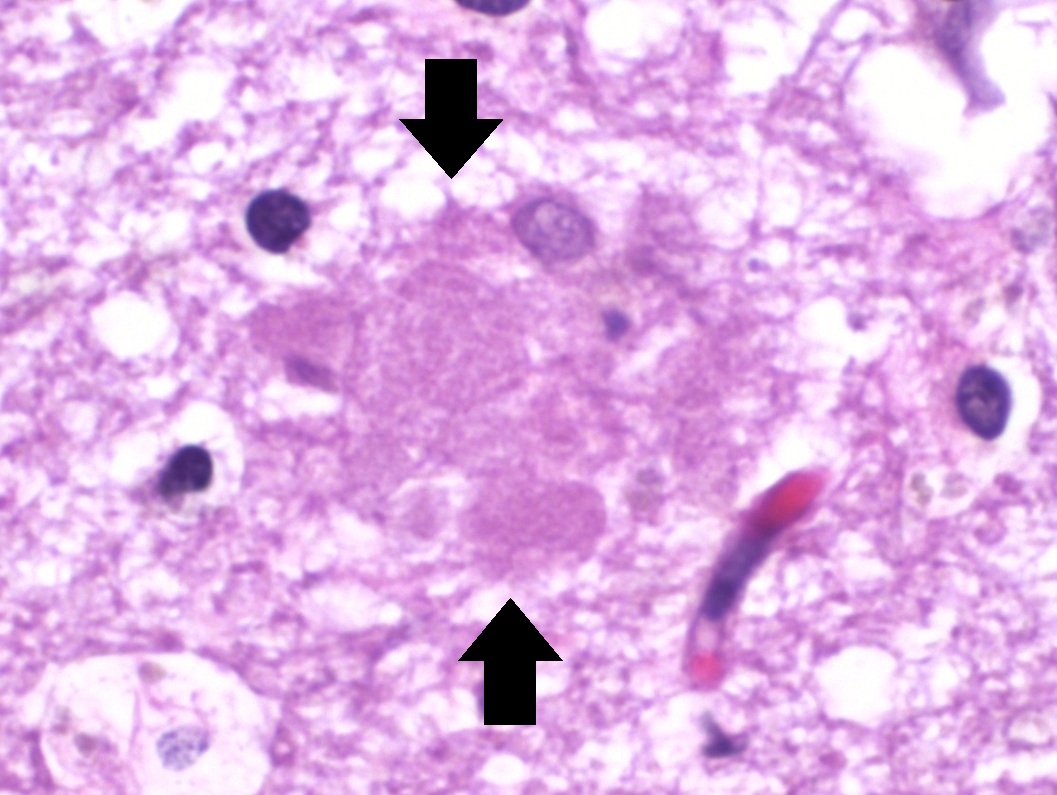 https://upload.wikimedia.org/wikipedia/commons/2/2d/Histopathology_of_amyloid_plaque_in_Alzheimer%27s_disease_-_annotated.jpg