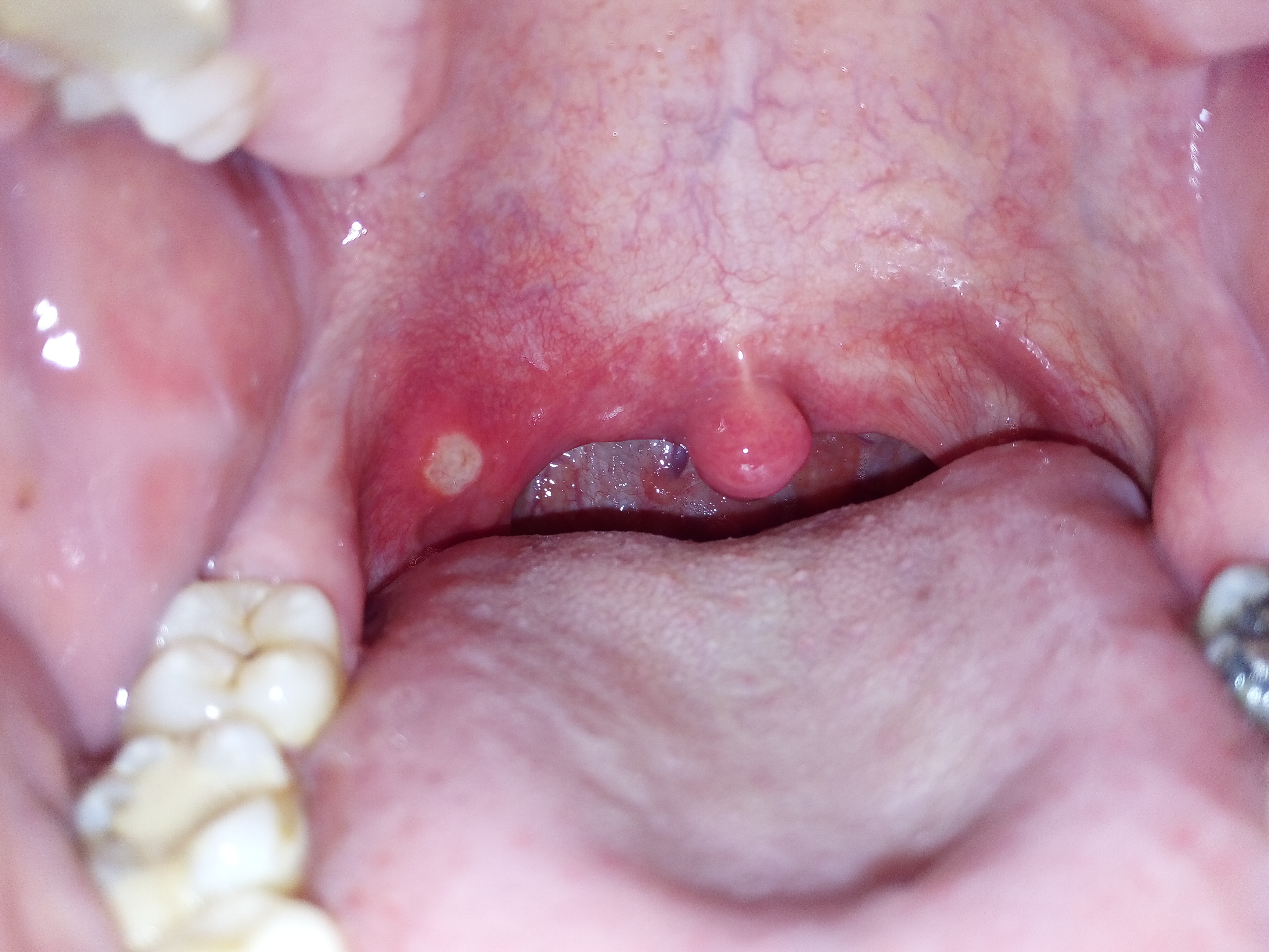 mouth ulcer