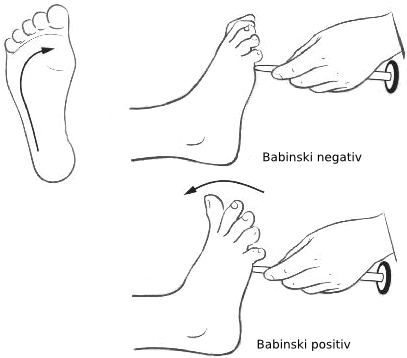 What to Know About the Babinski Reflex