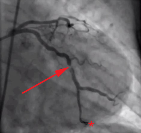 Тромб в правом. Коронарография инфаркт миокарда. Коронарография сосудов стентирование. Коронарография стеноз. Окклюзия коронарной артерии на коронарографии.