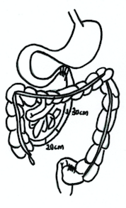 The surgical procedure of end-to-end jejunoileal bypass EE JI bypass.png