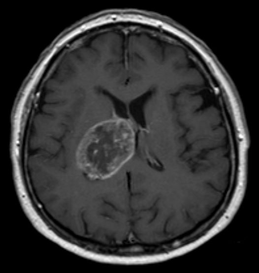 File:Glioblastoma multiforme - MRT T1KM ax.jpg