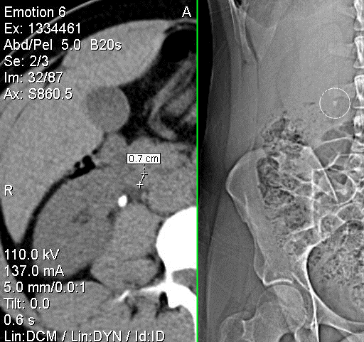 File:Rkidneystone.png