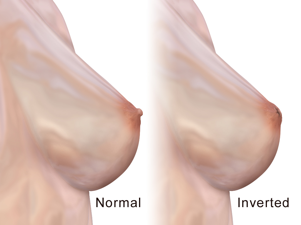 Common Causes and Treatment for Inverted Nipples