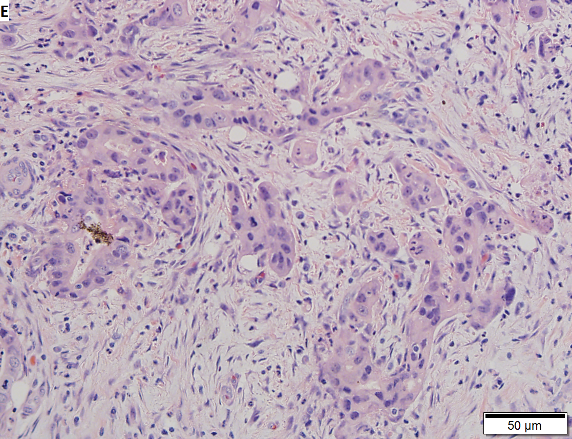 Moderately differentiated adenocarcinoma of gallbladder