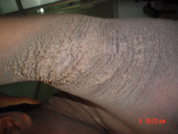 File:Familial acanthosis nigricans4.jpg - Wikimedia Commons