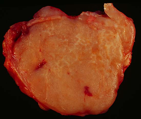 File:Malignant lymphoma, high grade B cell 1.jpg