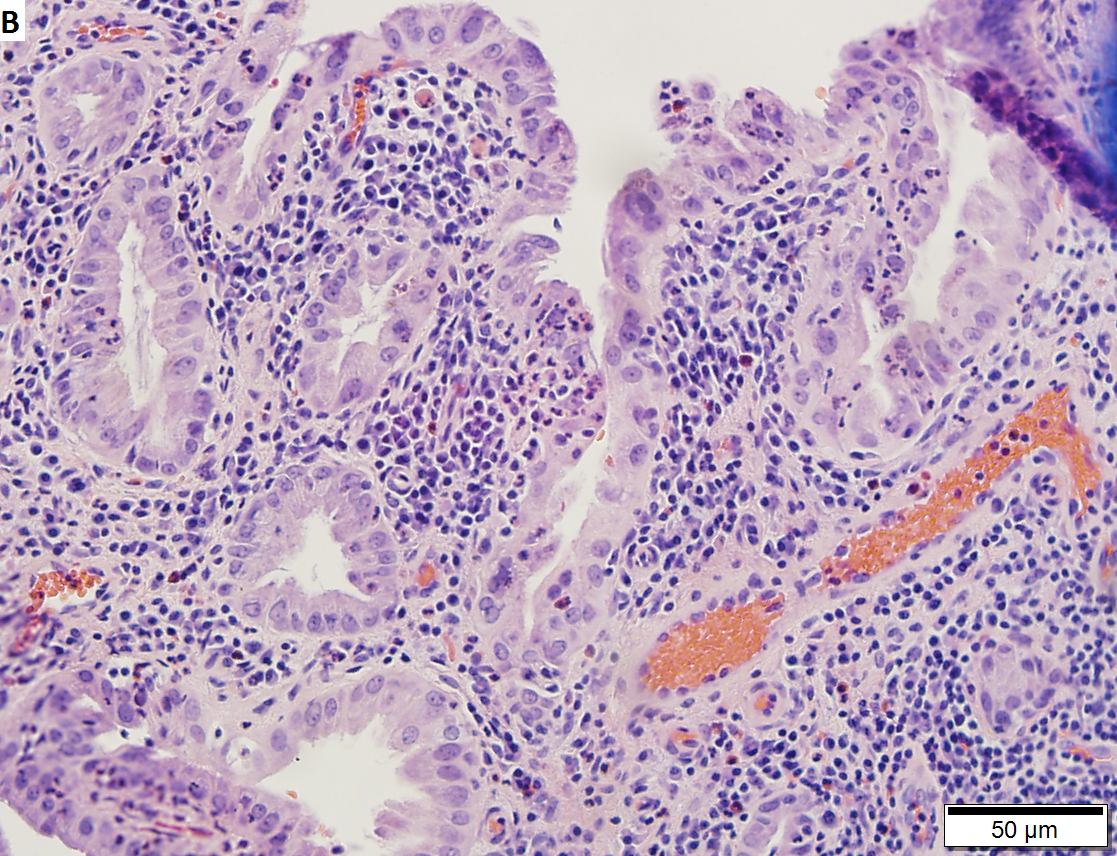 Chronic cholecystitis with reactive changes.