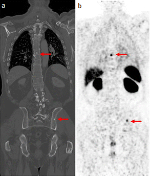 Medical images of a man's torso. Arrows indicate tumour metastases, visible as dots in the man's spine and pelvis, in both scans.