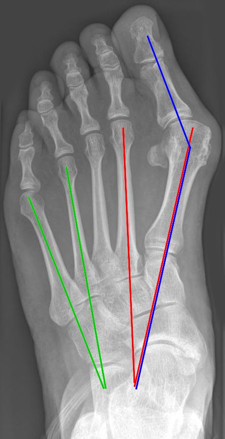 Hallux valgus