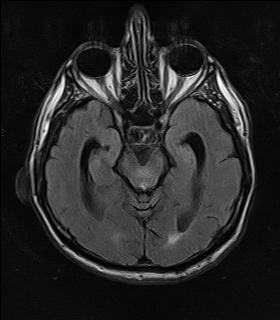 File:NPH MRI 113.png