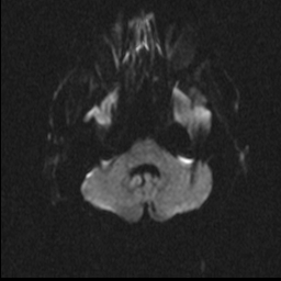 File:NPH MRI 198.png