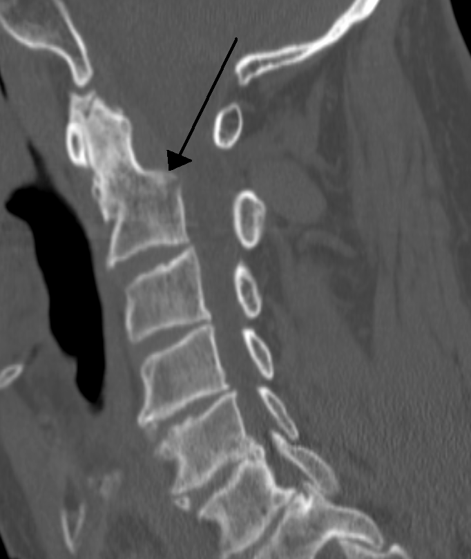 dislocated neck x ray