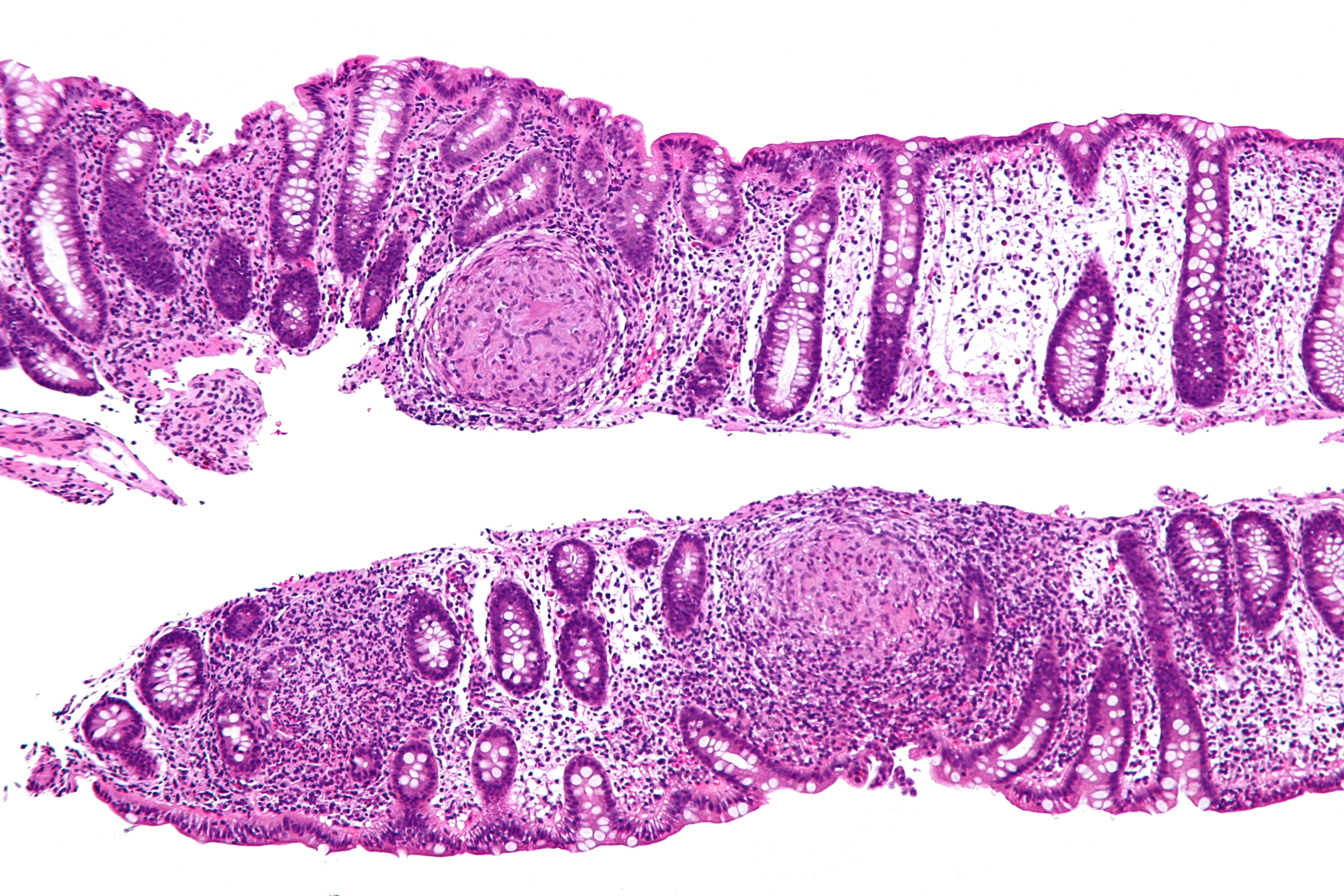 what is crohn disease