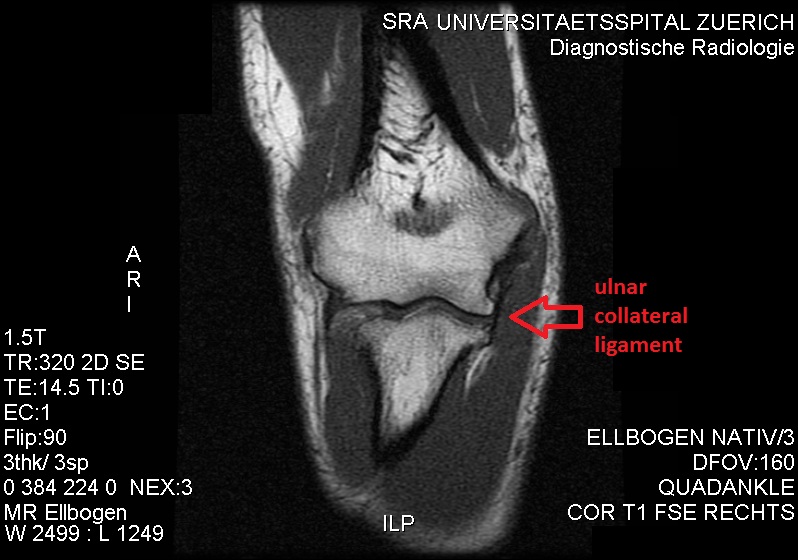 File:MRI. Unimpaired ulnar collateral ligament..jpg