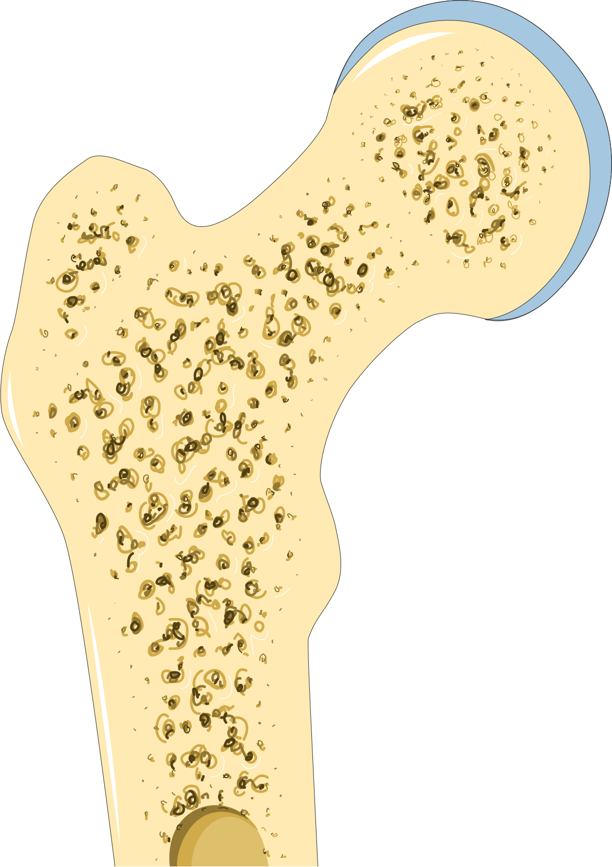 File:Osteoporosis 3 -- Smart-Servier.png - Wikimedia Commons
