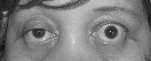 Ptosis myasthenia gravis