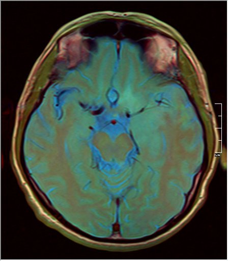 File:Brain MRI 0211 12.jpg