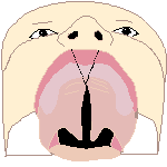 Cleft palate 2 bot.png