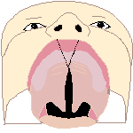 File:Cleft palate 2 bot.png