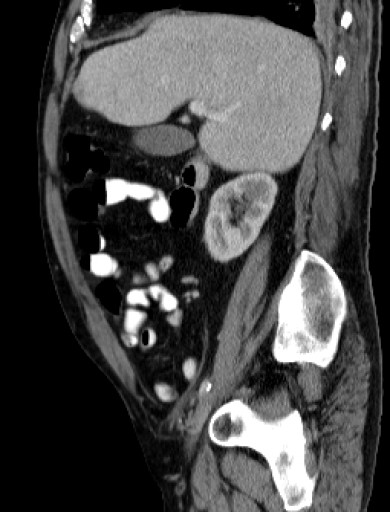 File:Hufeisenniere 03 - CT - sagittal - 007.jpg