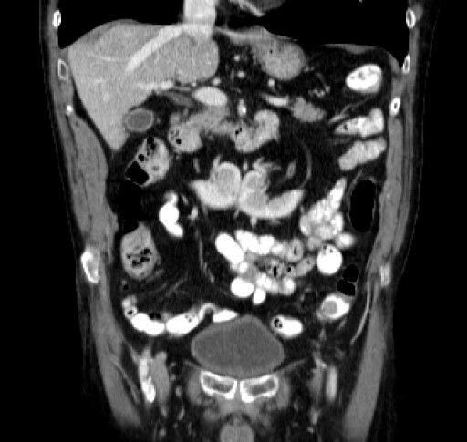 File:Hufeisenniere 07 - CT - coronar - 005.jpg