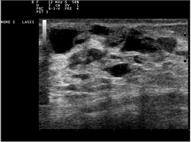 intraductal papilloma ultrasound)
