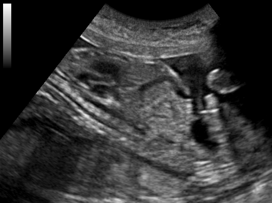 File:Ultrasound Scan ND 111702 1120490 cr.png