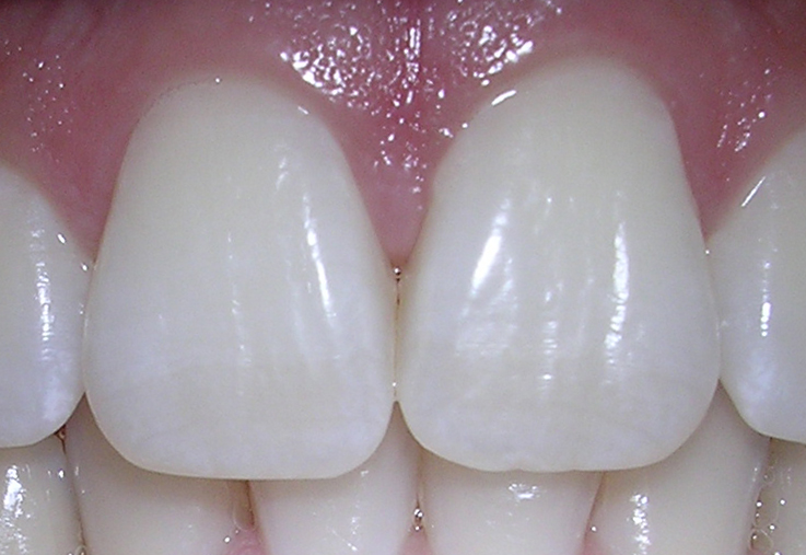 File:06-10-06centralincisors.jpg