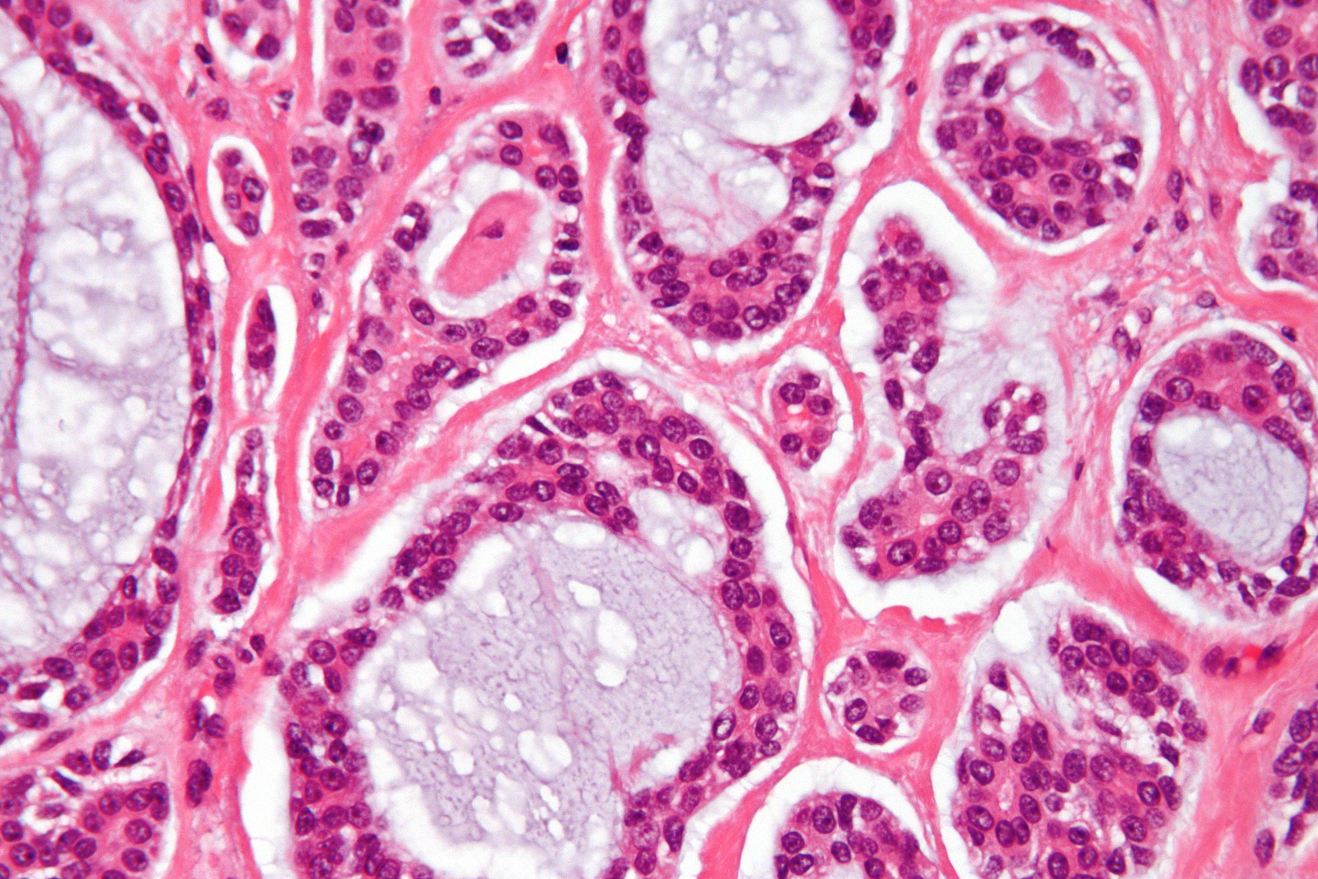 Adenoid cystic carcinoma. Gyertyák fájdalomcsillapítás a prostatitisből