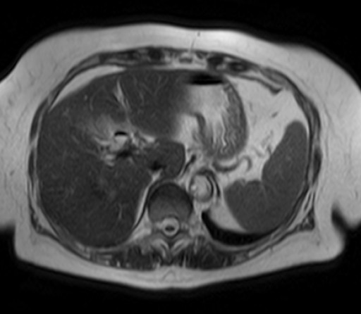 File:Bouveret-Syndrom case 001 - MRT - T2 axial - 011.jpg