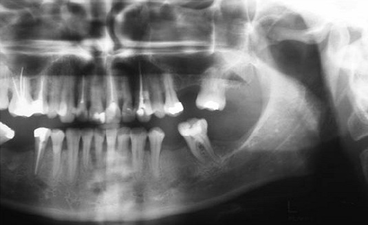 File:COMPROMISO ARTICULAR TEMPOROMANDIBULAR (CAT).jpg